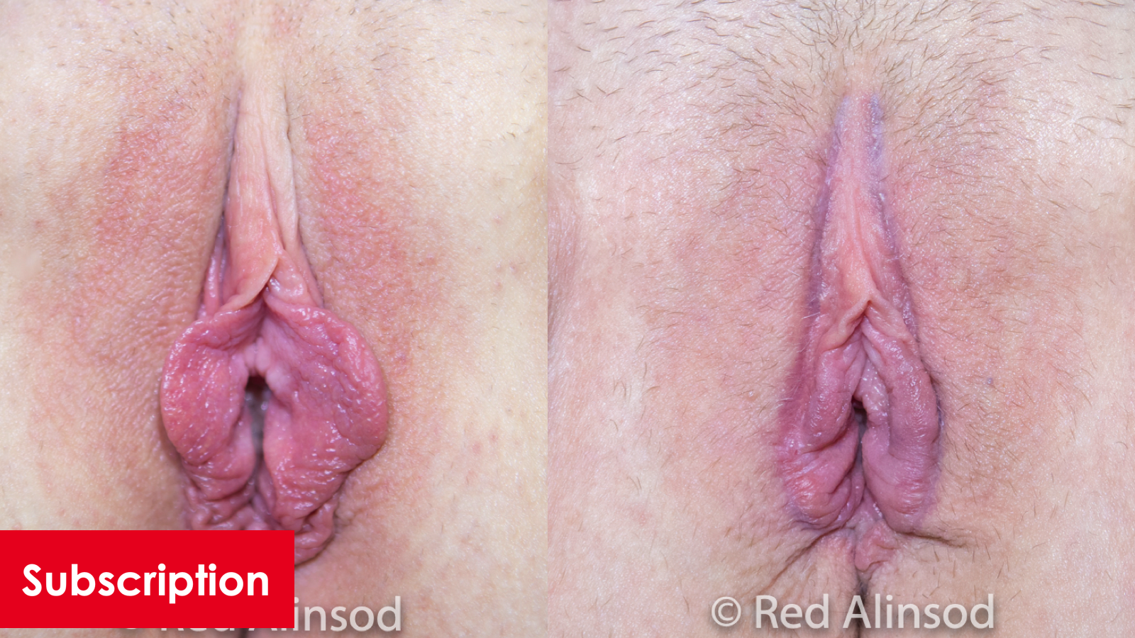 Majoraplasty with Rim Labiaplasty