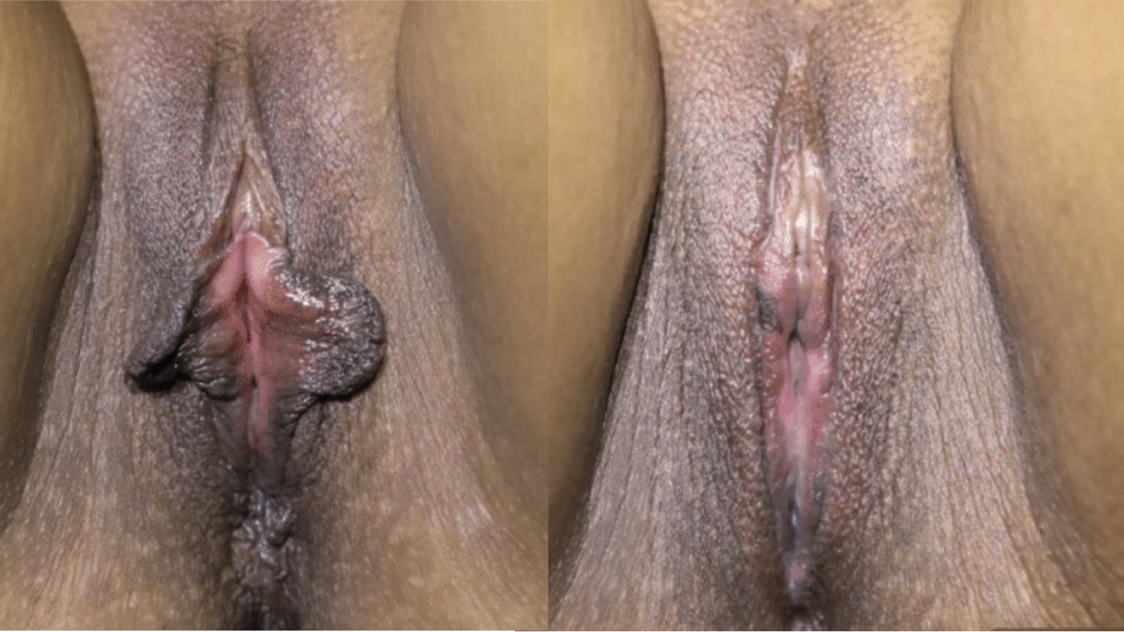 Vaginoplasty, Perineoplasty, Post Rep, MP, Barbie LP, CHR, Anal Skin Tag