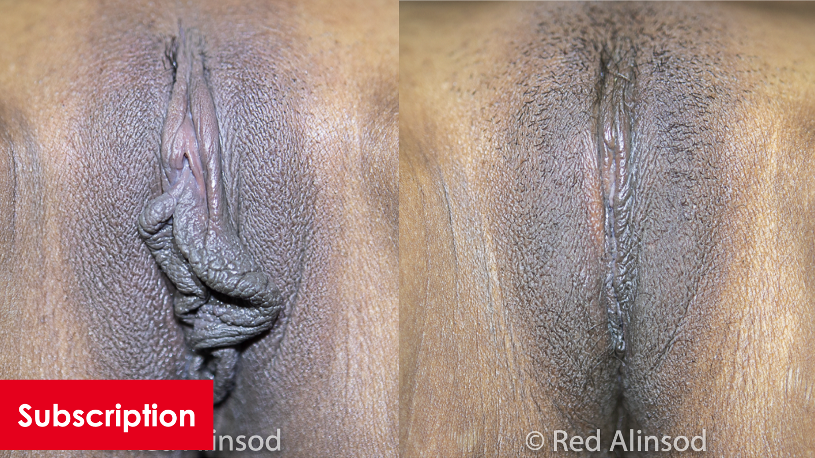 Perineoplasty, Vaginoplasty, Barbie Labiaplasty, Medial and Lateral A Incisions