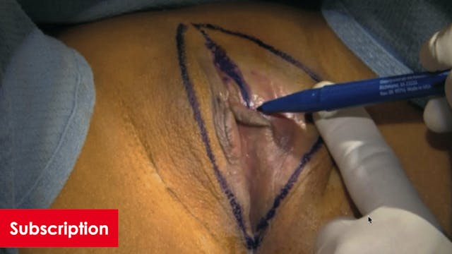 Labia Majoraplasty Anesthesia and Marking with Fat Pad Reduction