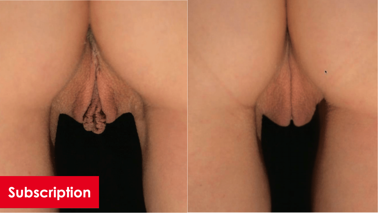 Combined Vaginoplasty and Labiaplasty with Clitoral Hood Reduction