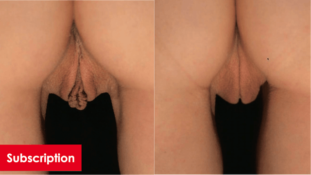 Combined Vaginoplasty and Labiaplasty...