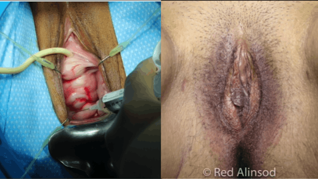 Transvaginal Uterine Suspension: Pelvic Reconstruction with Dermal Augmentation