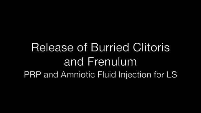 AIAVS Fellows Video 24, Release of Buried Clitoris and Frenulum, PRP and Amniotic Fluid Injection