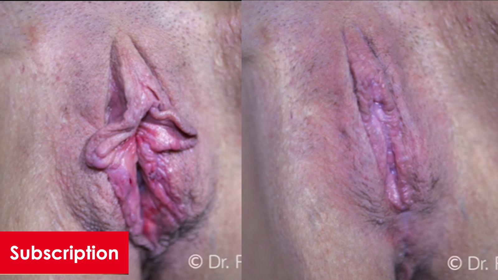 Perineoplasty, Wedge Labiaplasty Revision, Clitoral Hood Reduction, and O-shot