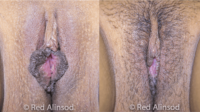 Hybrid Labiaplasty