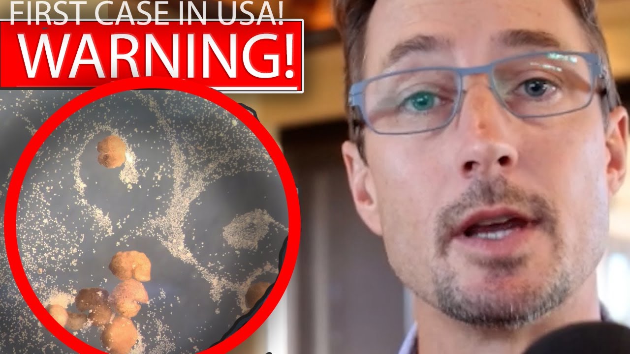 BREAKING NEWS!! IT'S HERE.. FIRST CONFIRMED CASE DETECTED!!!