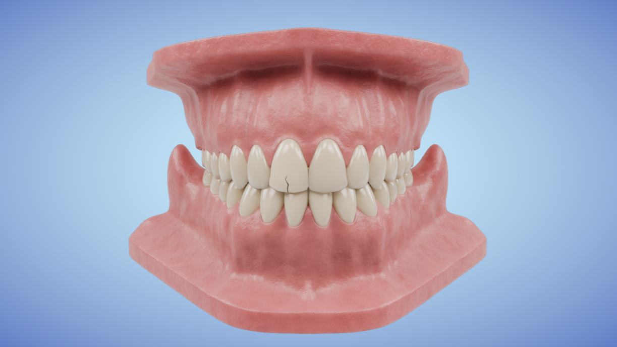 Crown Prep of Damaged Tooth