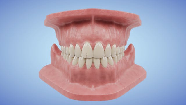 Crown Prep of Damaged Tooth