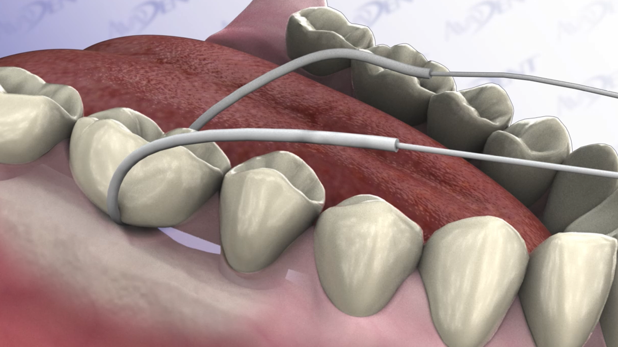 Cleaning a Three-Unit Bridge - Flossing with a Floss Threader