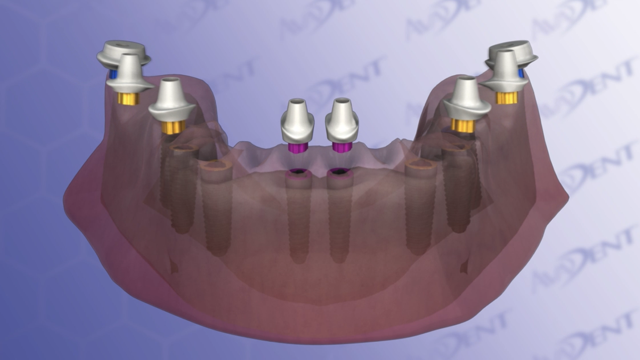 Mandible Crown and Bridge Reconstruction