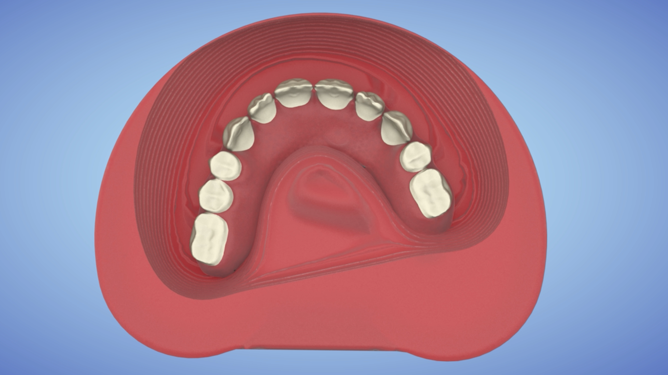 AvaMax Hybrid Fixed Ti-SpaceTruss Bar