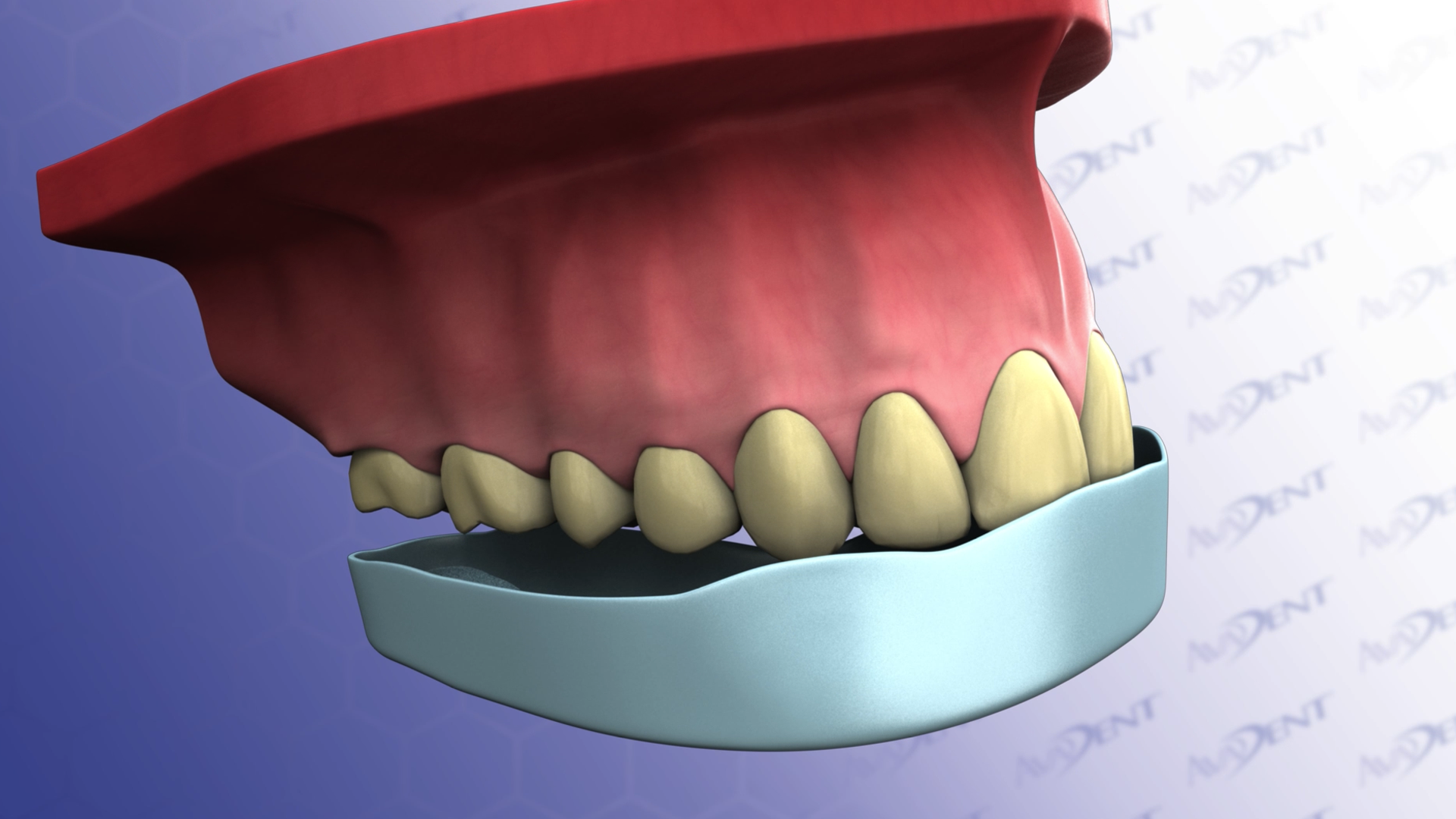 Whitening with Trays