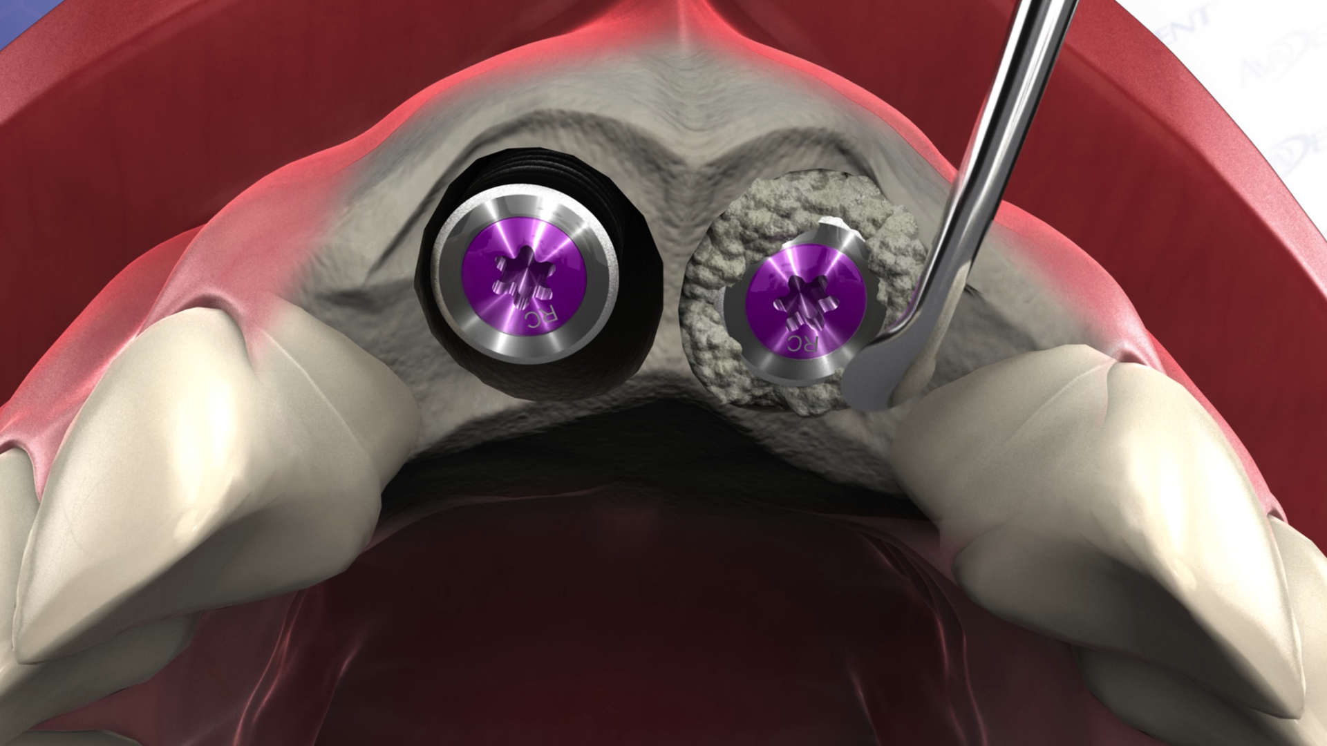 Implant Placement into Socket - Two Central Incisors