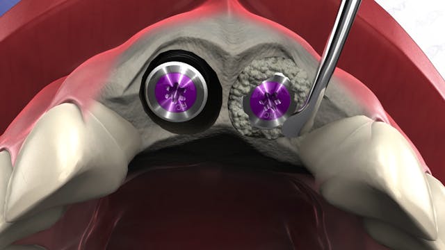 Implant Placement into Socket - Two C...