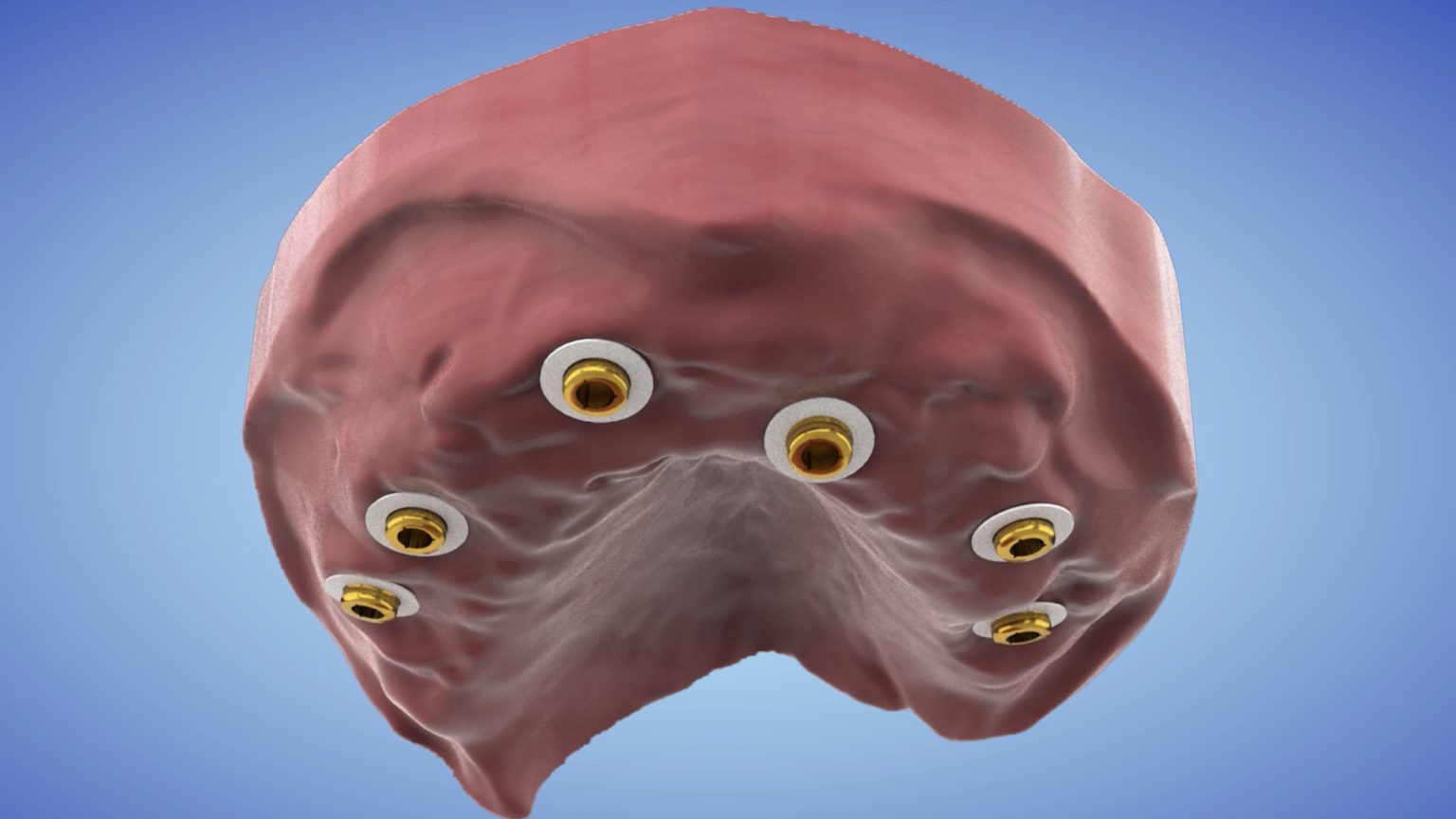Clinical Pickup Workflow for AvaMax Hybrid Locator Fixed Ti-SpaceTruss Bar