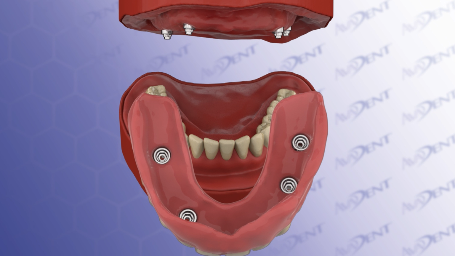 Upper Fixed Detachable