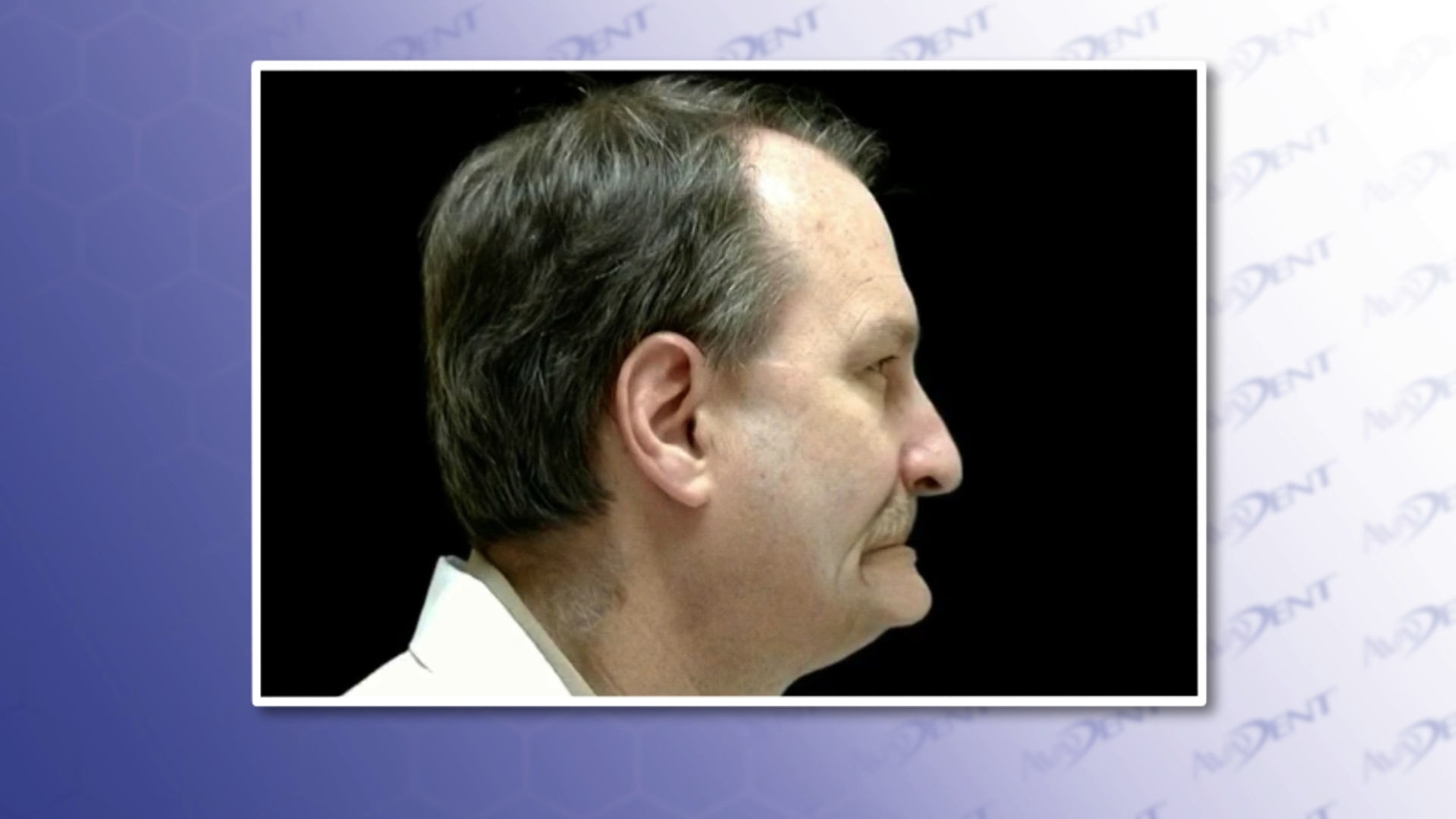 Premature Aging Do To Bone Loss - Male Side View