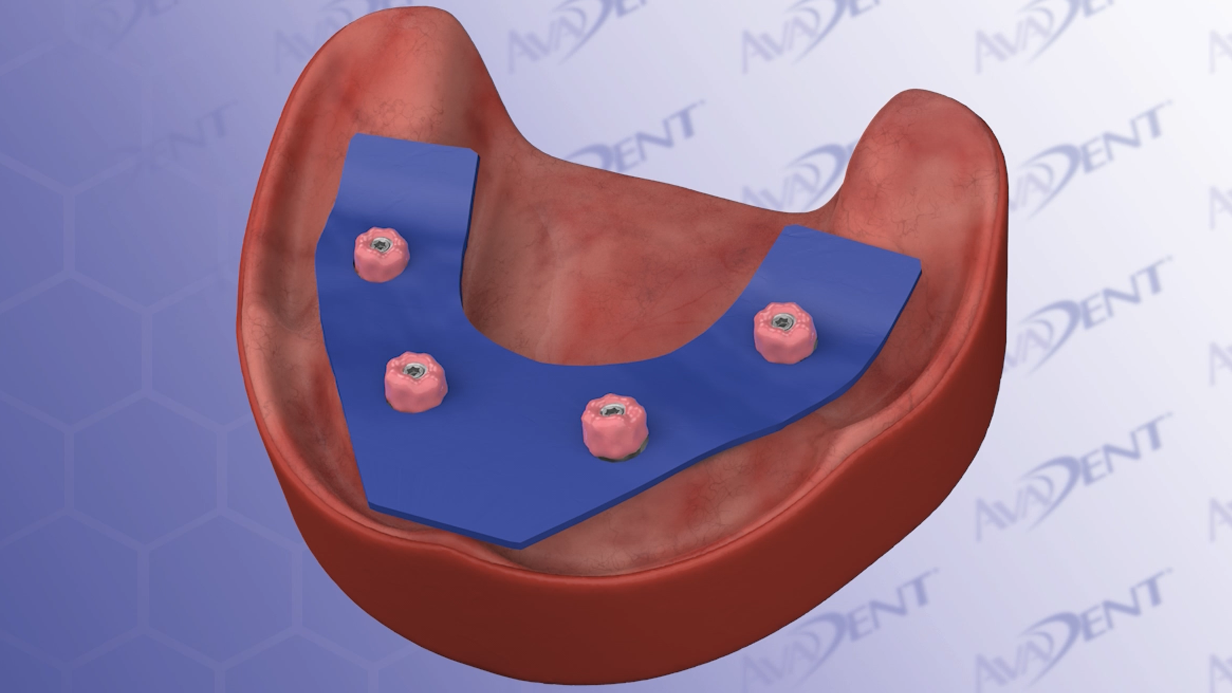 Smart Denture Conversion