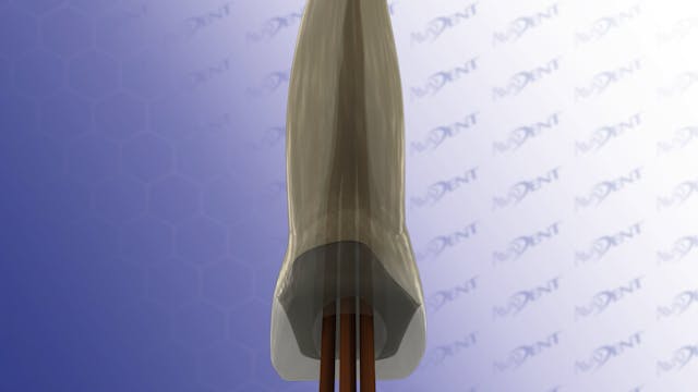 Root Canal with a Crown