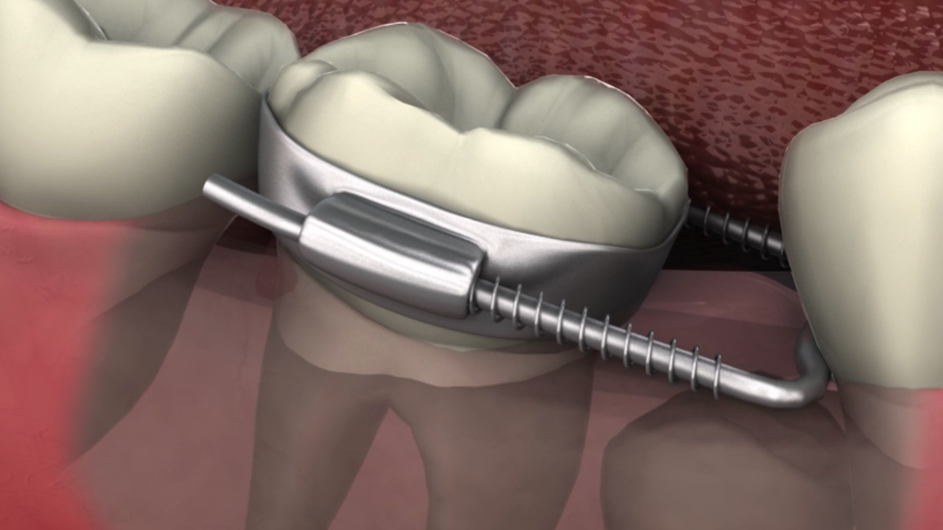 Space Regainer - Lower Posterior