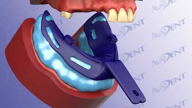 Manual Impressions for Immediate Dent...
