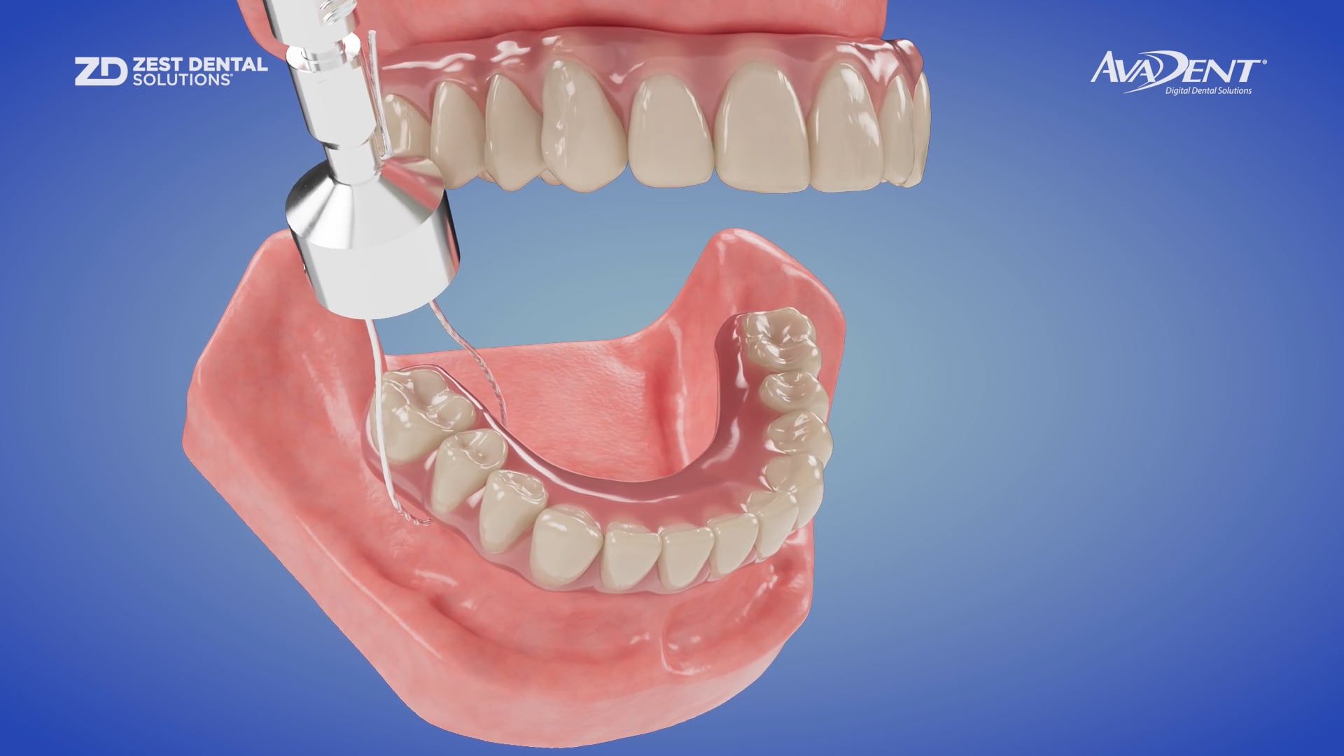 The AvaDent LOCATOR FIXED Conversion Denture Procedure