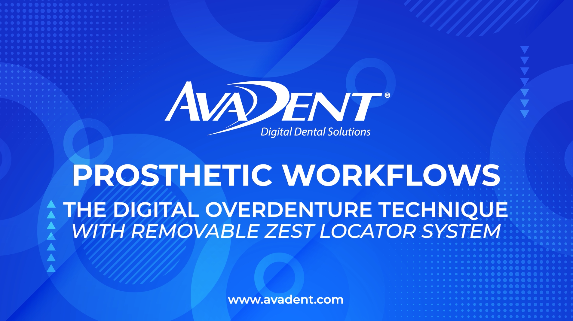 AvaDent Prosthetic Workflows: The Digital Overdenture Technique