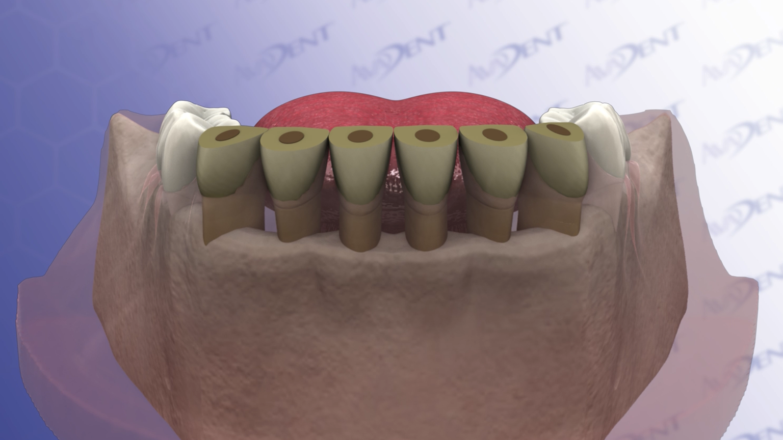 Crown Lengthening - Overview