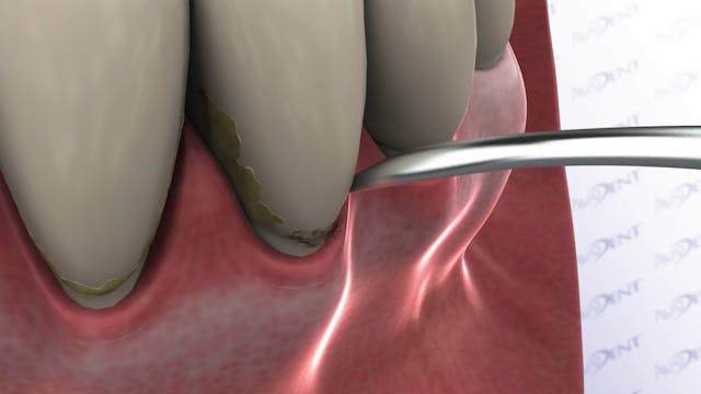 Ultrasonic Scaling