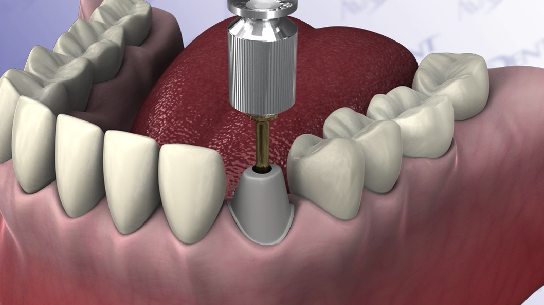 Single Tooth Two Stage Procedure - Lower Cuspid
