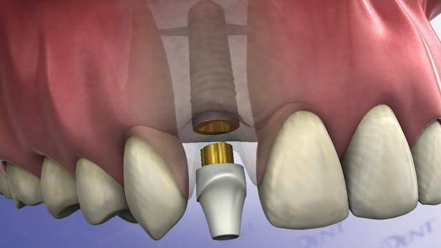 Implant vs. Bridge
