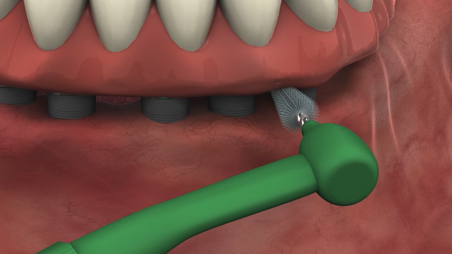 Cleaning a Fixed-Detachable with a Micro Brush