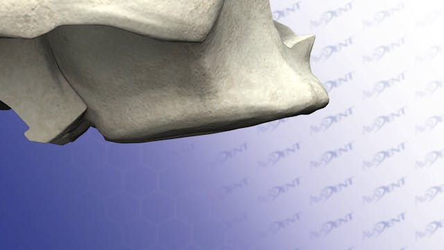Bone Atrophy - Upper Maxilla