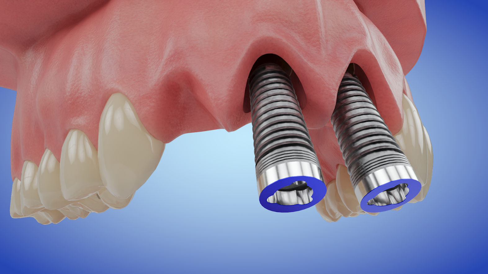 Implant Cantilever Bridge - Three Teeth