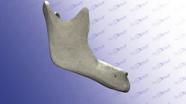 Bone Atrophy - Lower Mandible