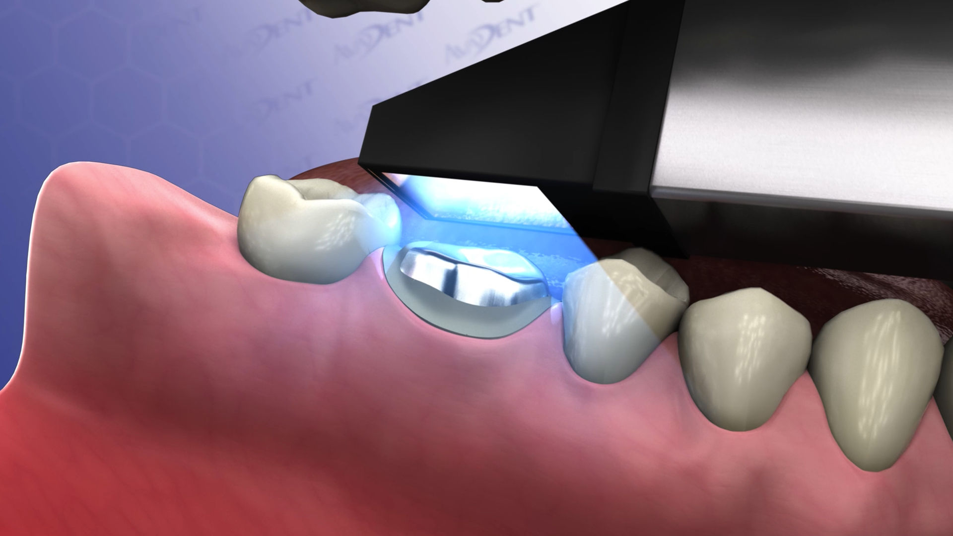 Crown with CAD-CAM System