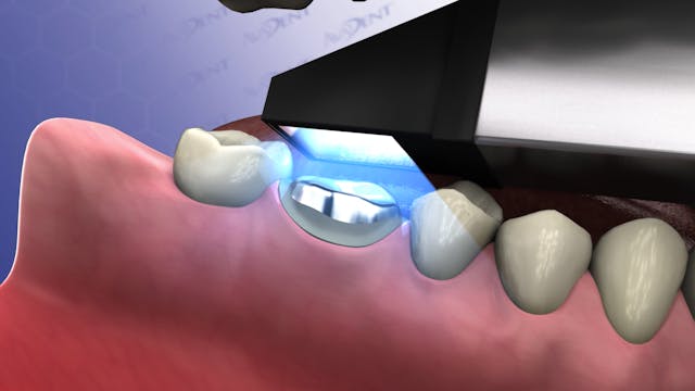 Crown with CAD-CAM System