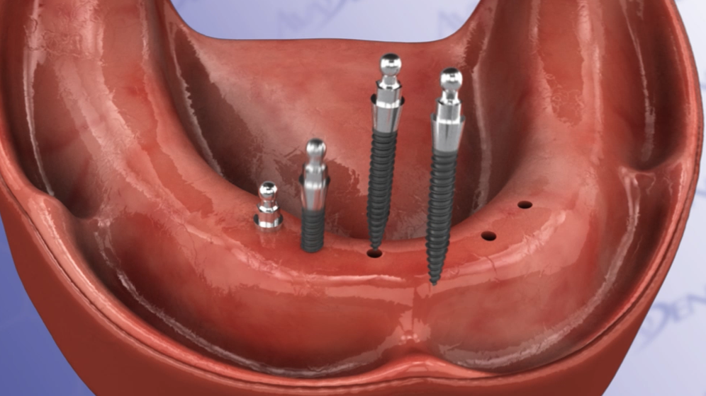 Lower Supported Denture by Mini-Implants