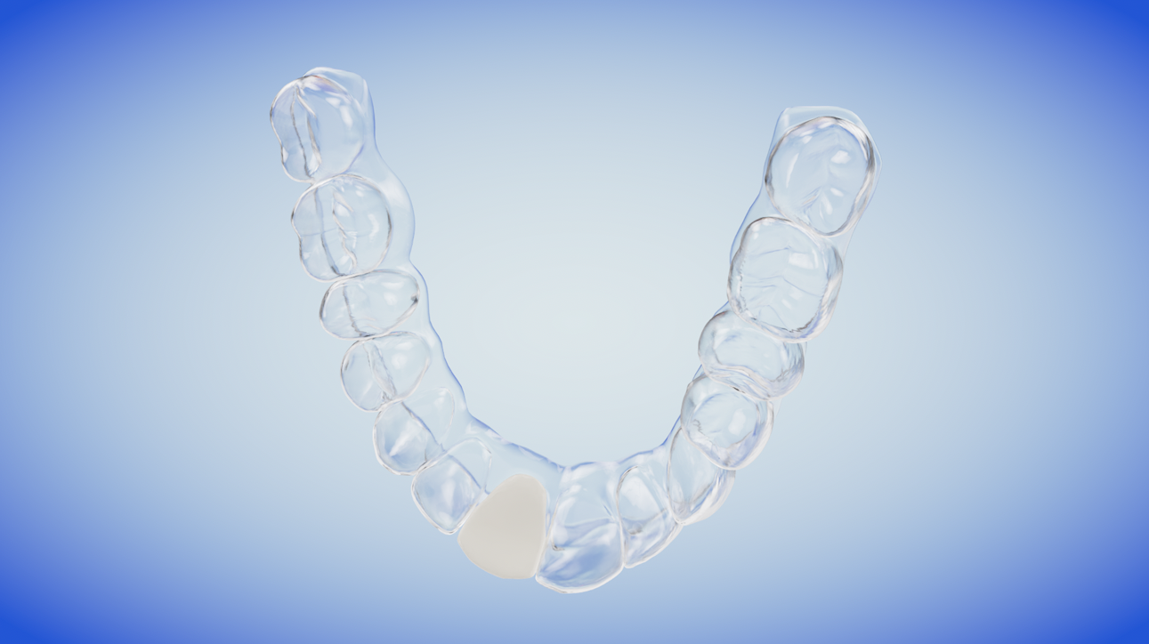 Essix Temporary Appliance