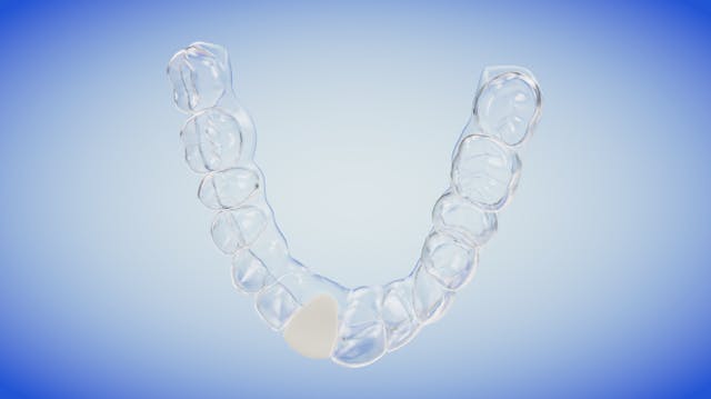 Essix Temporary Appliance