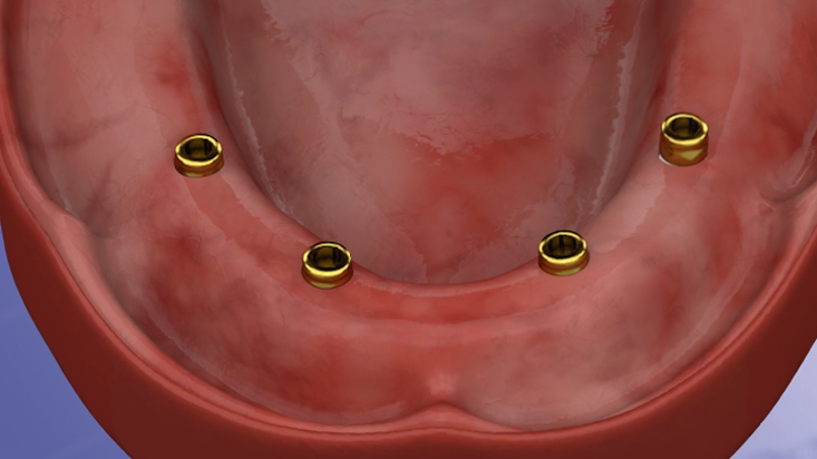 Locator Attachments for Lower Denture