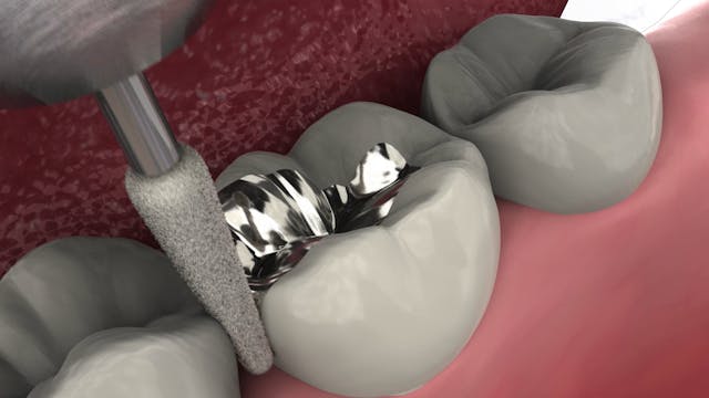 Esthetic Inlays