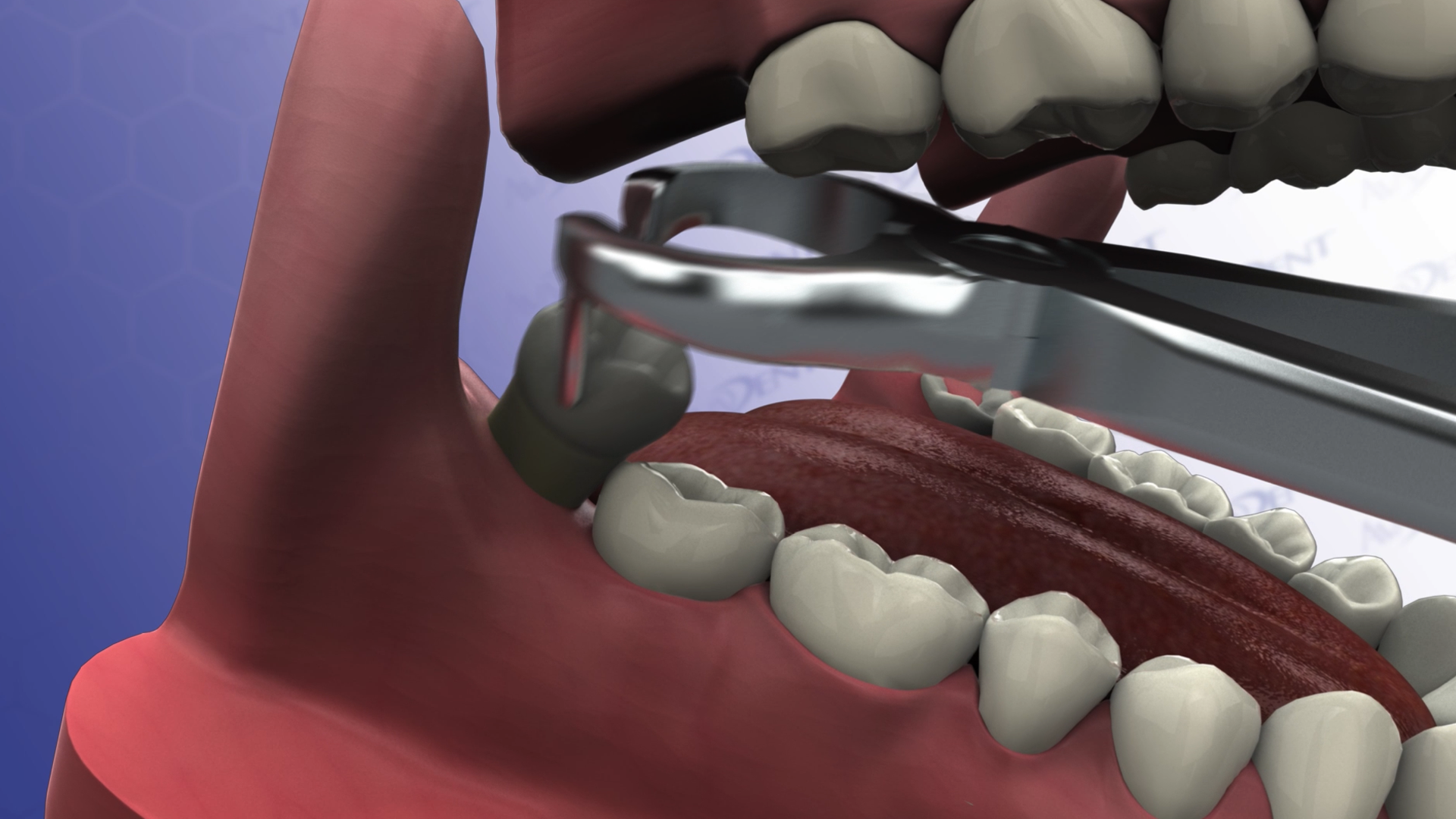 Third-Molar Extraction - Wisdom Teeth