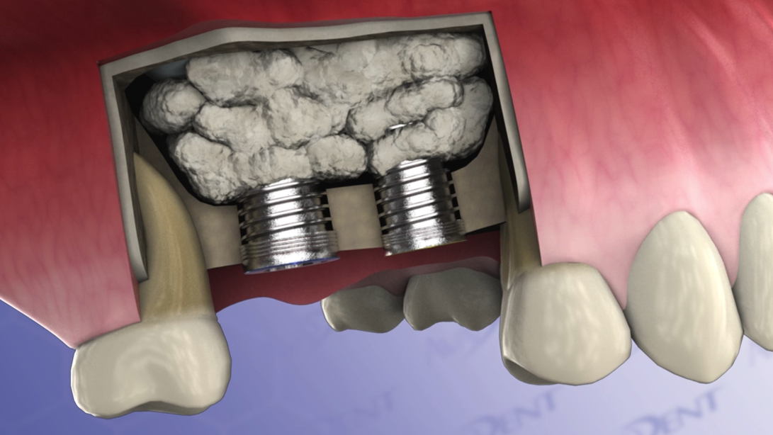 Sinus Lift with Vertical Approach - Summers Technique