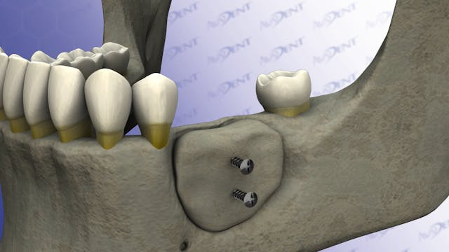 Bone Grafting - Lower Maxilla new