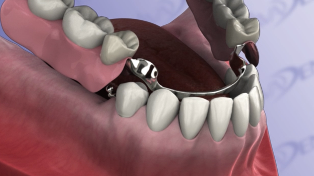 Removable Precision Partial Denture