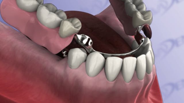 Removable Precision Partial Denture
