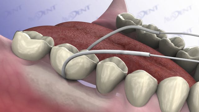 Cleaning and Implant-Supported Three-...