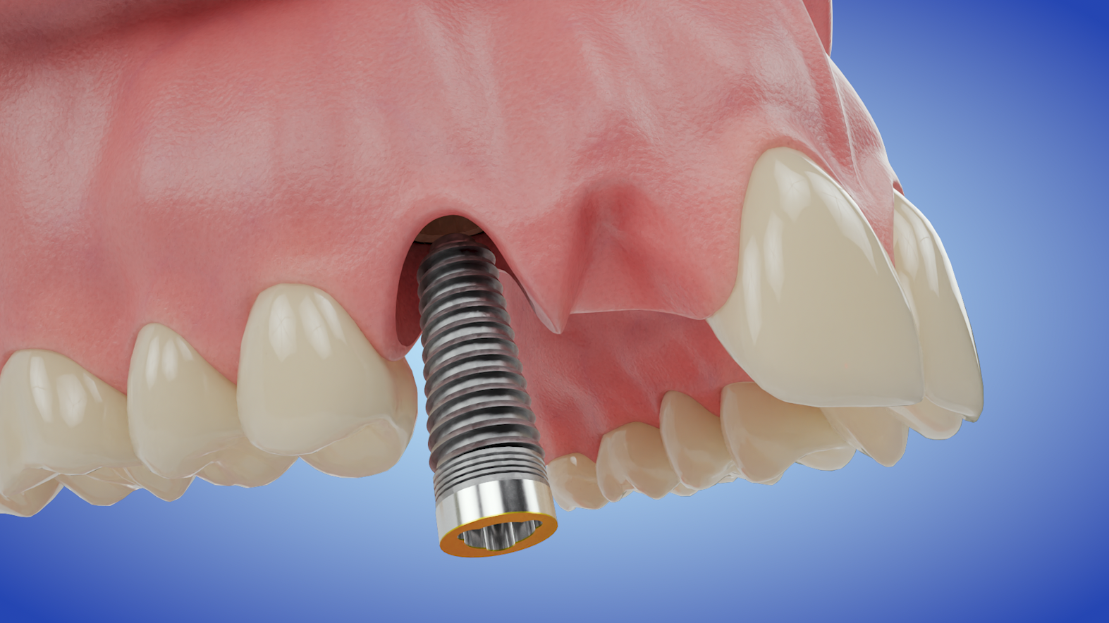 Implant Cantilever Bridge - Two Teeth